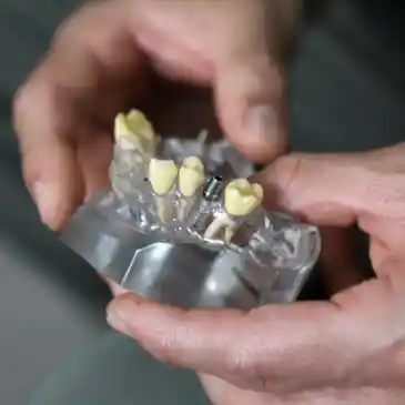 Implantes dentales